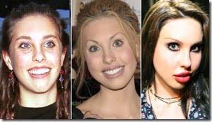 Chloe Lattanzi plastic surgery